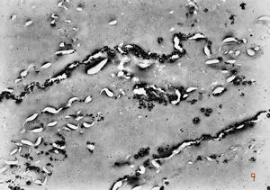 F,71y. | silver pigment in epidermal stratum corneum F,71y. | silver pigment in epidermal stratum corneum